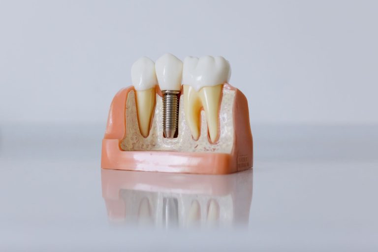 All-on-4 Dental Implants Price in Antalya, Turkey